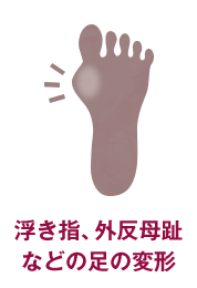 浮き指、外反母趾などの足の変形