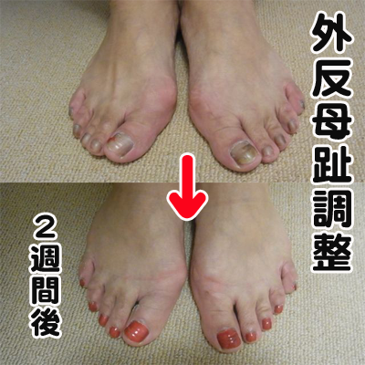 外反母趾痛みがなくなった 角度が変わってきた Pedi Smile ペディスマイル