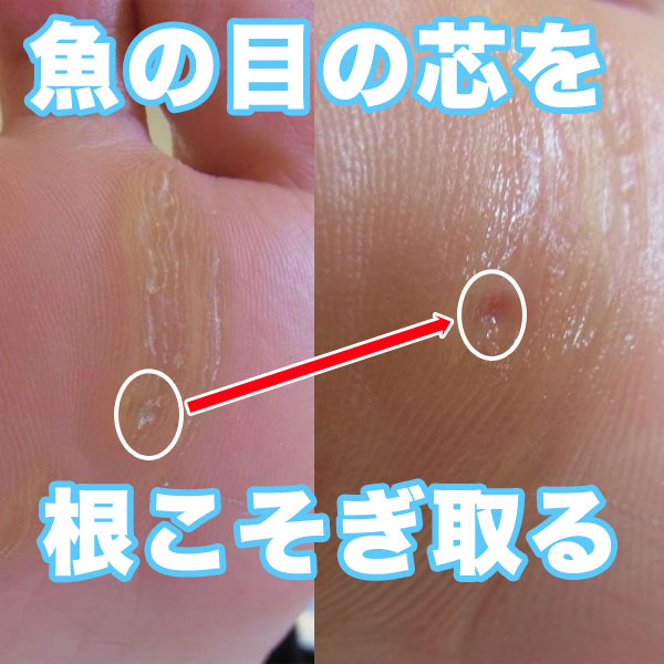 魚の目の芯根こそぎ取る Pedi Smile ペディスマイル