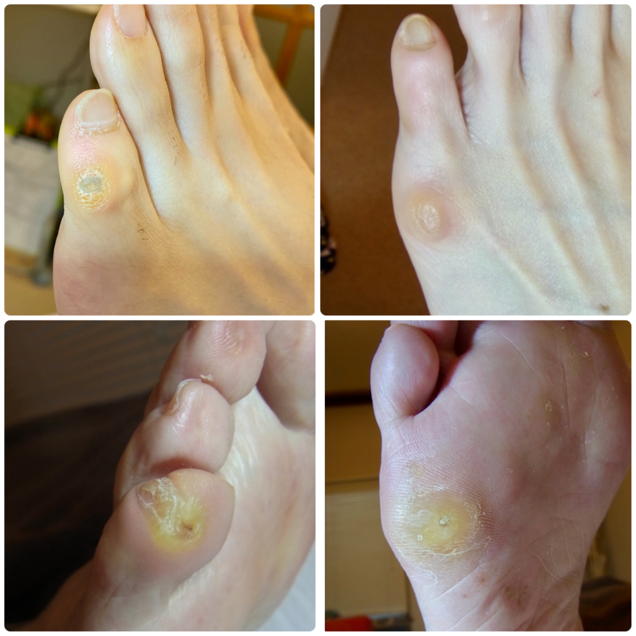 小指の魚の目いろいろ、じつは同じ原因で起きるのです Pedi Smile ペディスマイル 小指の魚の目いろいろ、じつは同じ原因で起きるのです Pedi Smile ペディスマイル
